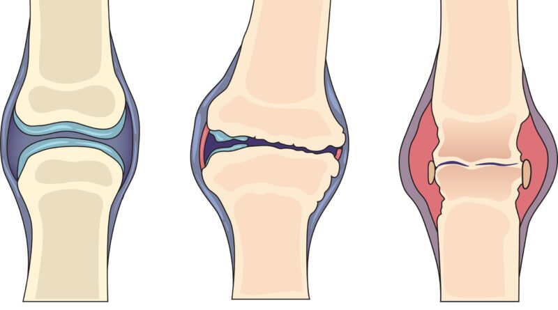 Rheumatoid-Arthritis