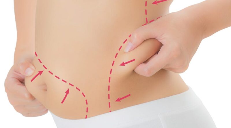 Liposuction