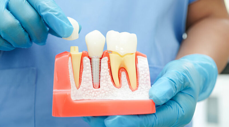 The Pros and Cons of Different Dental Implant Types: Making Informed Decisions for Your Smile