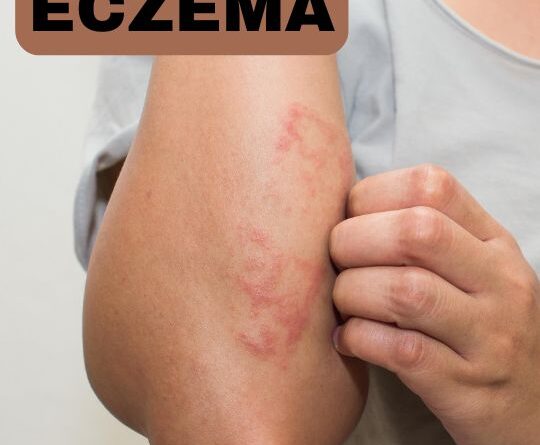 eczema