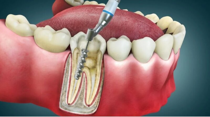 root canal treatment