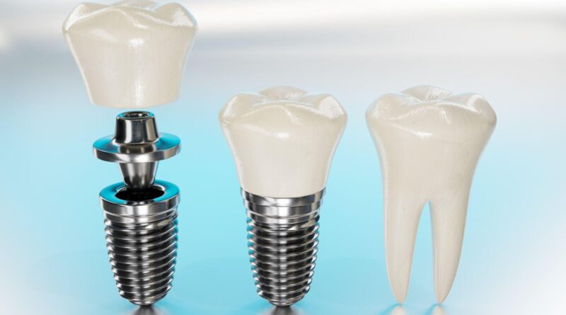 Dental Implants in Aberdeen