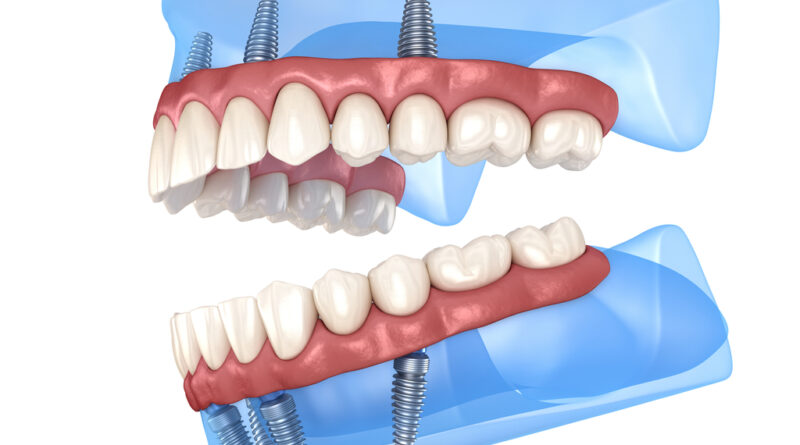 All-on-4 Dental Implants: The Solution to your missing teeth