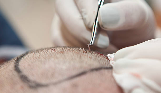 Hair transplant in Abu Dhabi