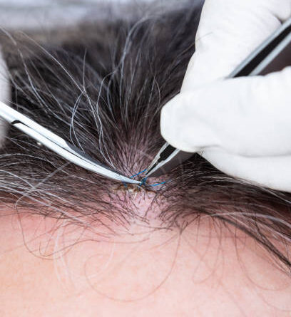 Fuss Hair Transplant in Abu Dhabi