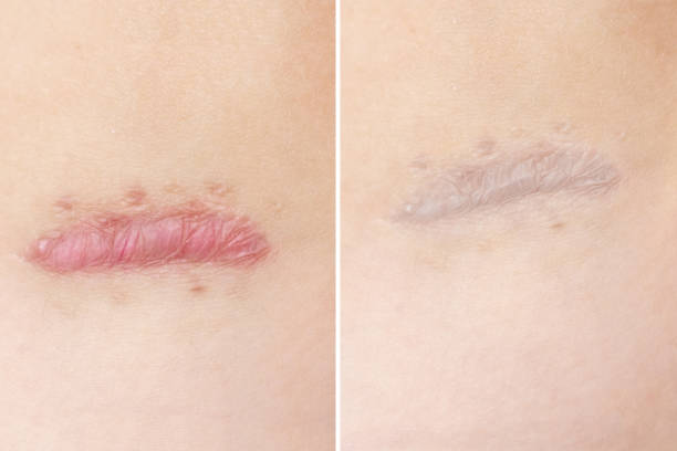 hypertrophic scar removal in Abu Dhabi