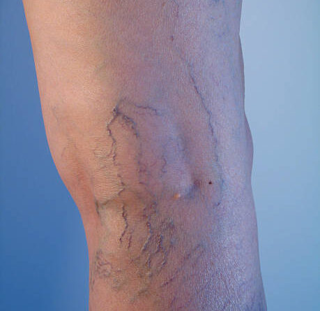 Spider Veins Treatment in Abu Dhabi