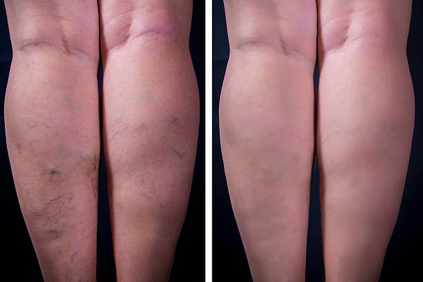 Varicose Veins Treatment in Abu Dhabi