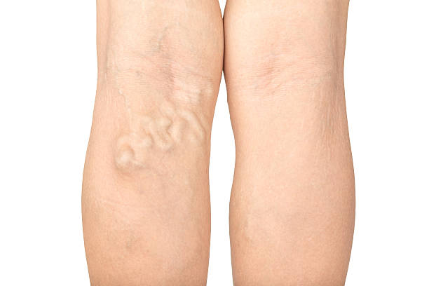 Varicose Veins Treatment in Abu Dhabi