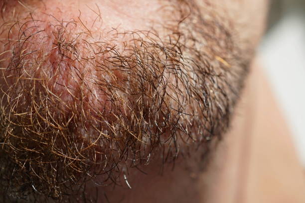 Sideburn Hair Transplant in Abu Dhabi