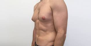 Gynecomastia Treatment Without Surgery