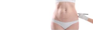 Liposuction surgery