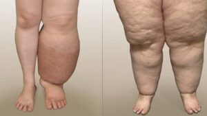 Lymphedema