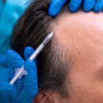 PRP Hair Treatment With Effective Hair Restoration