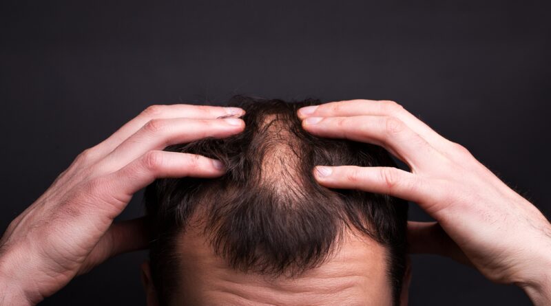 hair loss treatment in islamabad