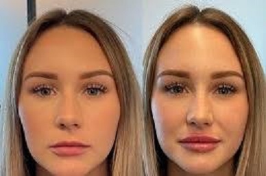 Sculptra fillers in Abu Dhabi