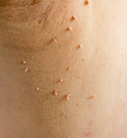 Skin Tag Removal in Abu Dhabi