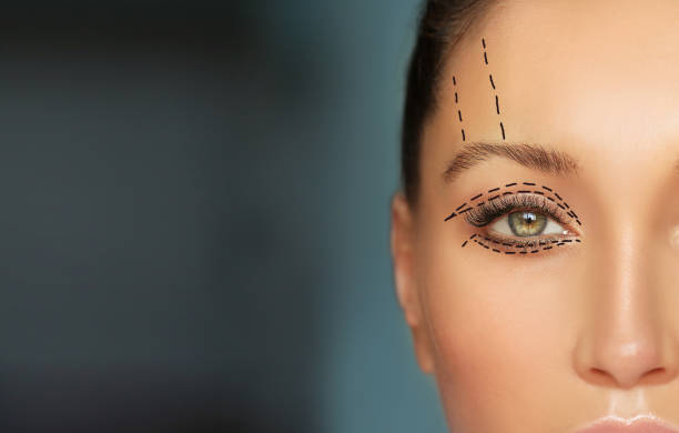 blepharoplasty surgery in Abu Dhabi