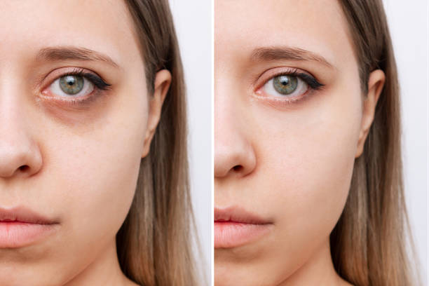 Eye bag removal in Abu Dhabi