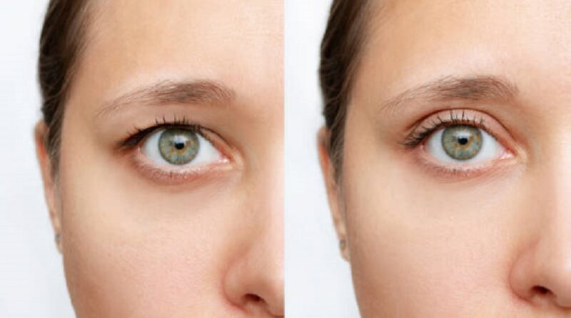 Eyelid surgery in Abu Dhabi