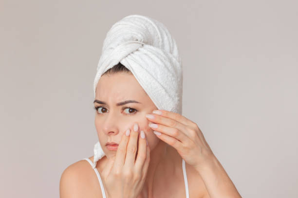 Acne treatment in Abu Dhabi