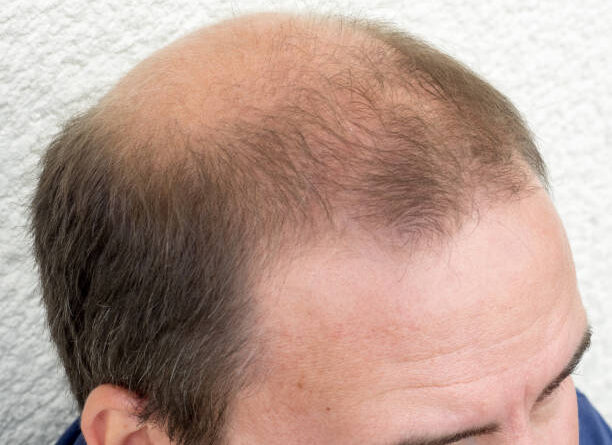 Sideburn Hair Transplant in Abu Dhabi