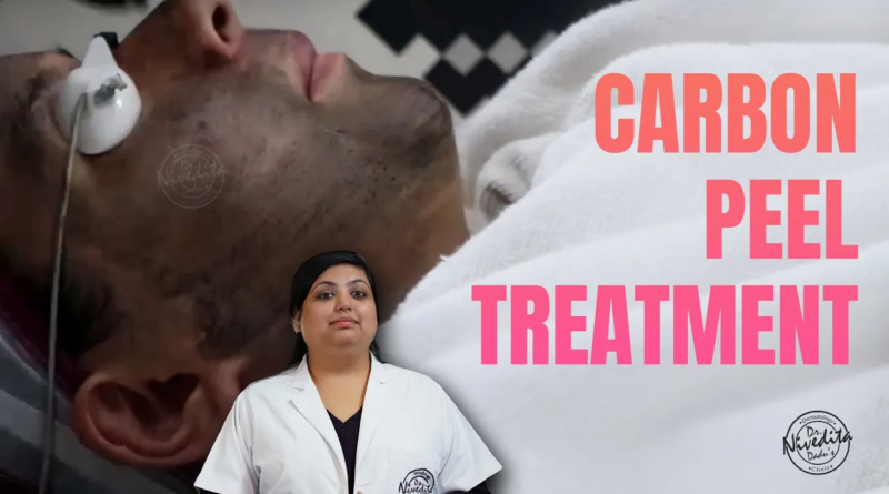 Carbon Peel laser treatment