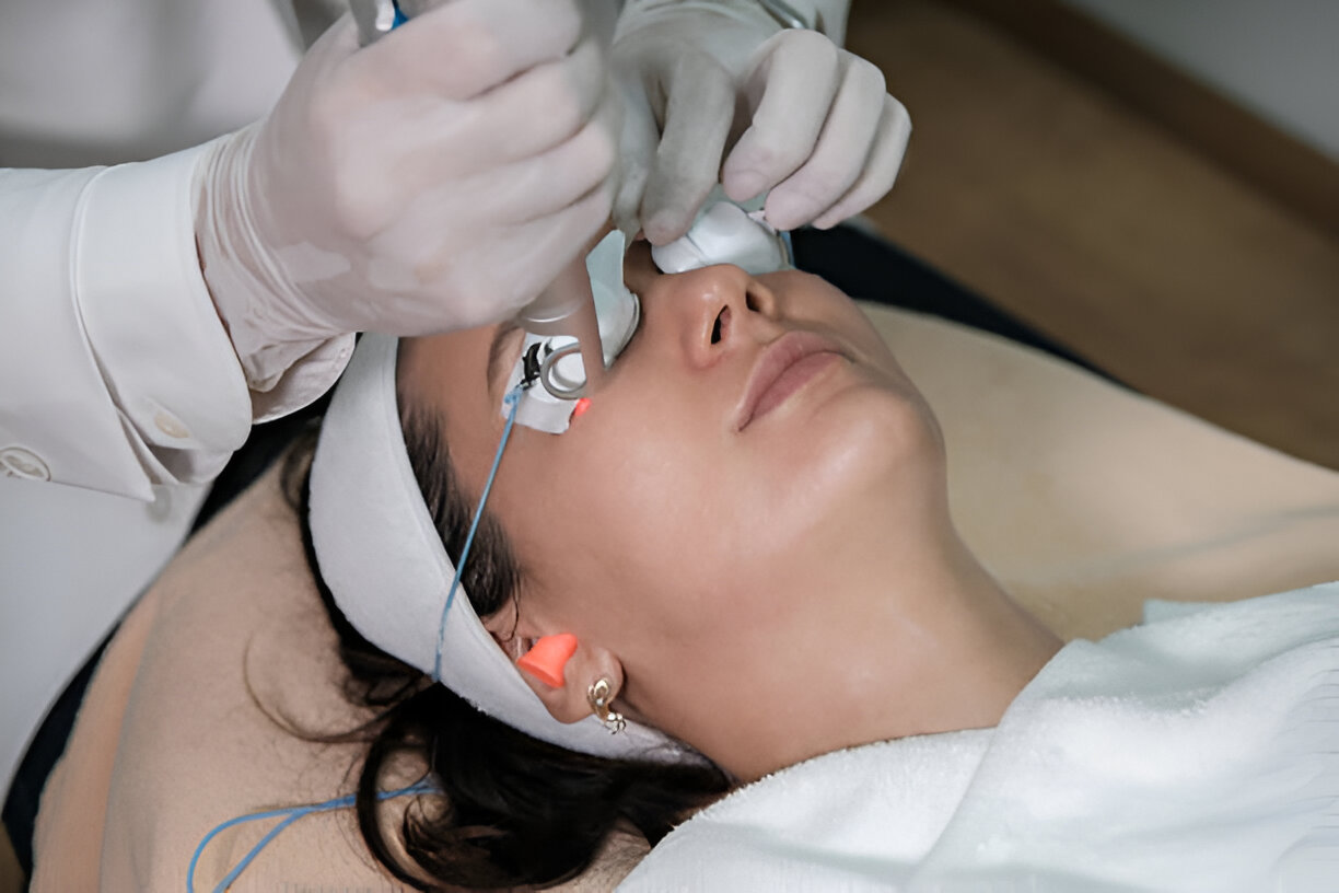 rf microneedling morpheus8