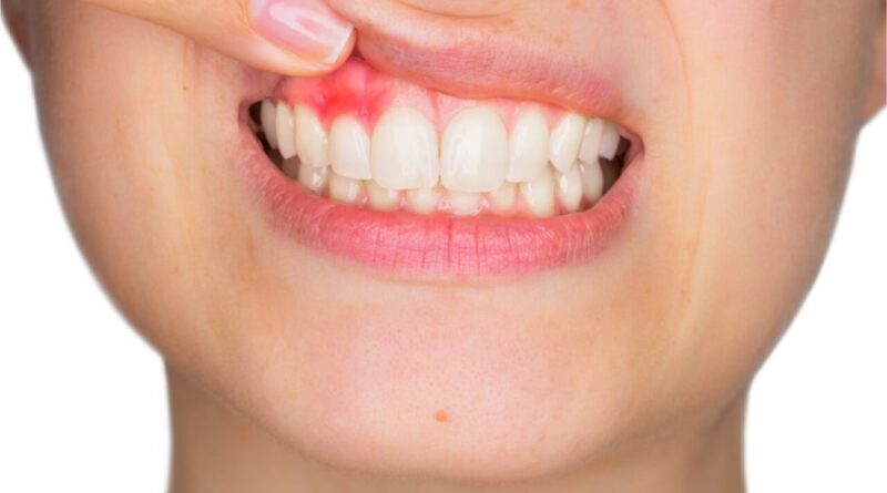 Tooth Abscess